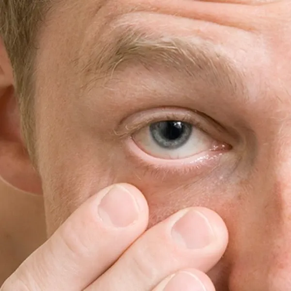 Conjunctivitus